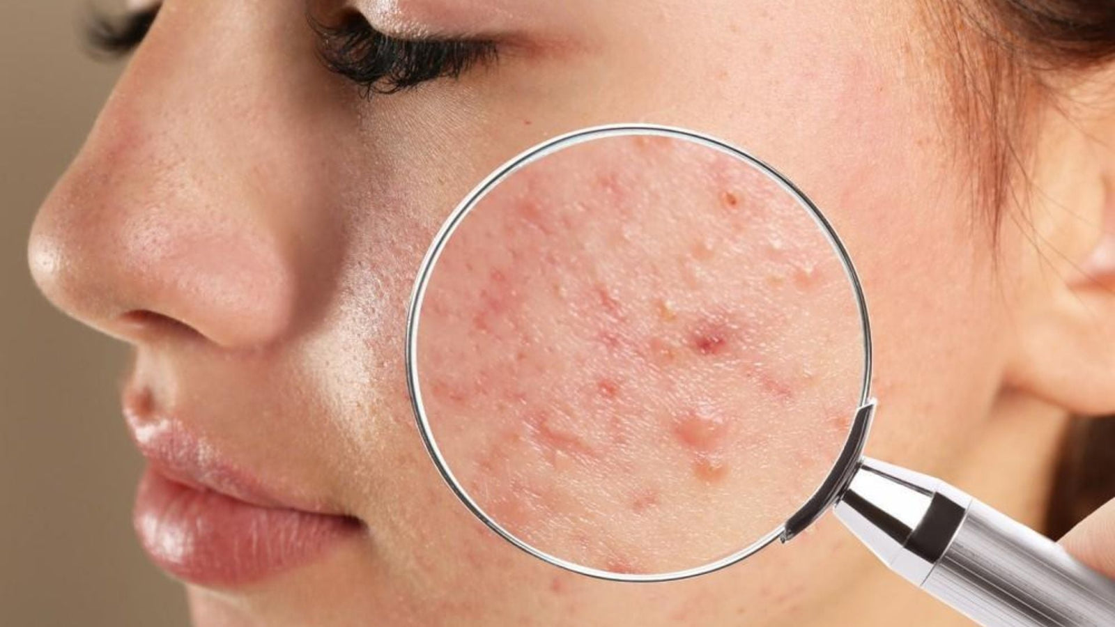 The Ultimate Anti-Acne Routine for Adults: Hormones, Stress & Skincare That Actually Works