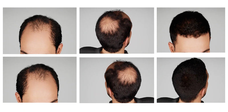 Men’s Hair Loss Solutions: Peptides, Caffeine & DHT Blockers — What Really Works